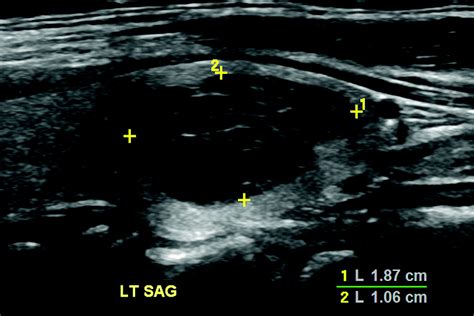 Assessment Of American College Of Radiology Thyroid Imaging Reporting