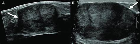 Benign Phyllodes Tumor A Year Old Woman Presented Complaining Of A