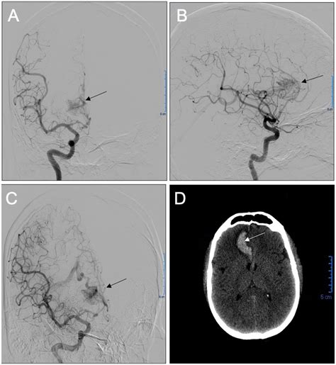 Frontiers Case Report A Combination Of Nitroglycerin And Adenosine Proves Effective In