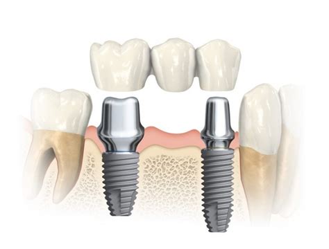 Dant Implantacija Dant Implantai Gera Kaina Auk Taitijos