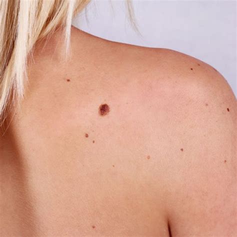 Moles And Birthmarks Bare Dermatology