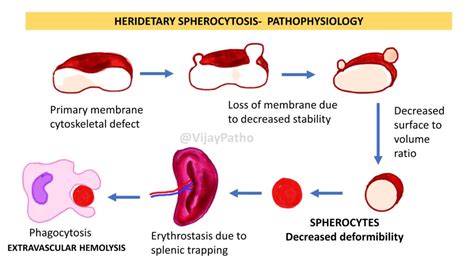 Pathology of Hereditary Spherocytosis - Pathology Made Simple