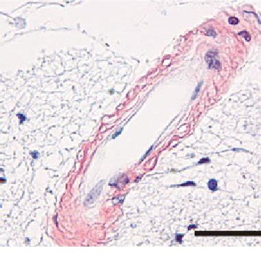 Representative photomicrographs of various grades of CAA. Congo Red... | Download Scientific Diagram