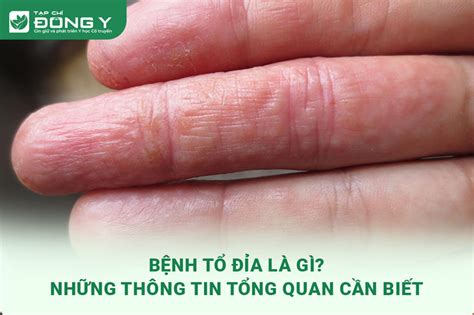 Bệnh Tổ Đỉa Là Gì? Những Thông Tin Tổng Quan Cần Biết