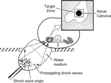 Complications of Lithotripsy | Anesthesia Key