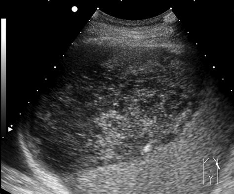 Sonography Of The Spleen Benter 2011 Journal Of Ultrasound In