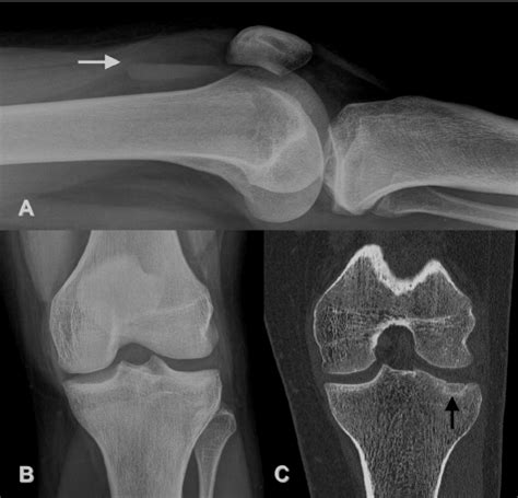 A Radiographie Standard Genou Gauche Profil Fl Che Blanche Niveau