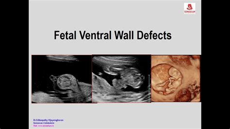 Fetal Ventral Wall Defects YouTube