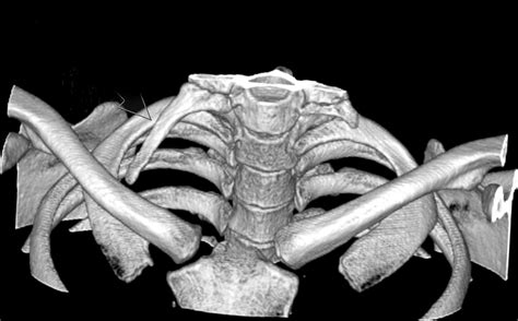 3d Ct Shows Right Side Dominant Cervical Ribs Download Scientific Diagram