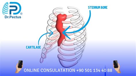 Pectus Excavatum Sunken Chest Causes And Risk Factors