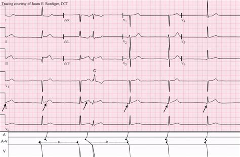 Junctional escape rhythm | ECG Guru - Instructor Resources