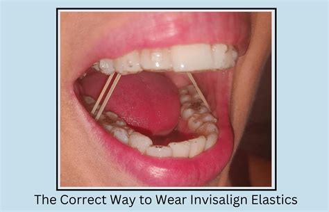 The Correct Way To Wear Invisalign Elastics Rubber Band Oral Health