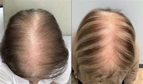 Hair Restoration Before After Photos Patient Washington Dc Mi