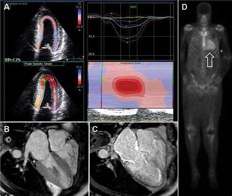 Cardiac Amyloidosis An Update On Diagnosis And Treatment Cleveland Clinic Journal Of Medicine