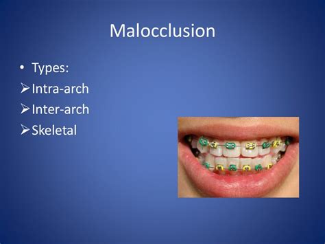 2occlusion Dental Vs Skeletal