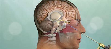 Brain Tumors Pituitary Disorders And Other Neurological Conditions