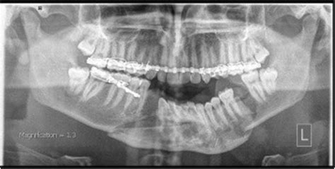 Imaging Of Mandibular Fractures A Pictorial Review 58 OFF