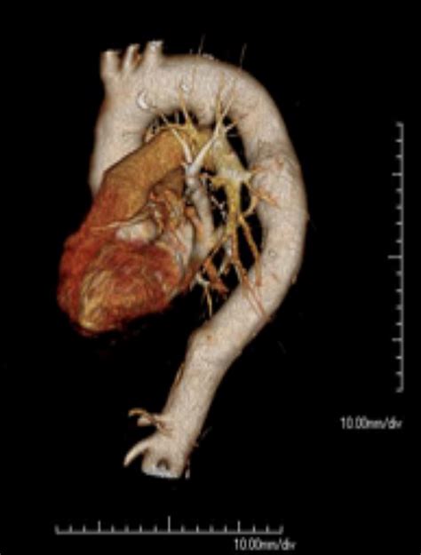 [figure The Image Shows The Thoracic ] Statpearls Ncbi Bookshelf