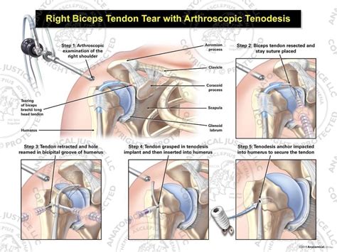 Arthroscopic Repair Of The Right Rotator Cuff Lupon Gov Ph