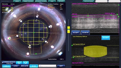 [hd] Lensx Procedure Femtosecond Laser Assisted Cataract Surgery Youtube