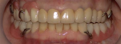 Протезирование зубов, изготовление и установка съемных протезов ...