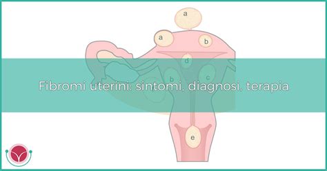 Fibromi Uterini Sintomi Diagnosi Terapia Luigi Fasolino