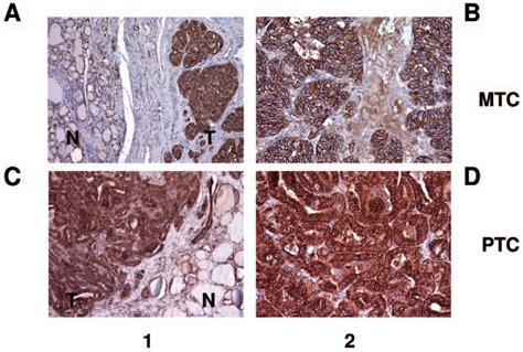 Immunohistochemical Analysis Of Alcam Membranous Positive Staining In Download Scientific