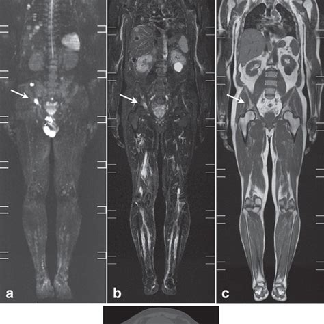 A Year Old Man With Multiple Malignant Melanoma Metastases The Ct