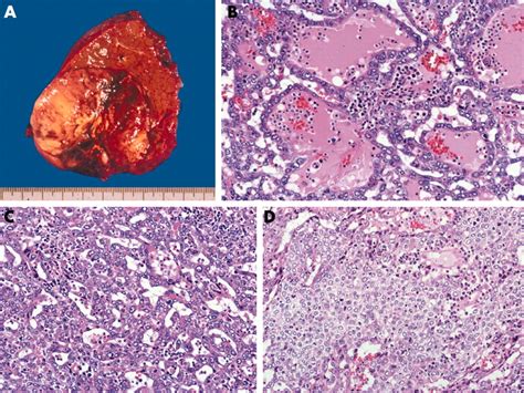 Hepatocellular Carcinoma Histology