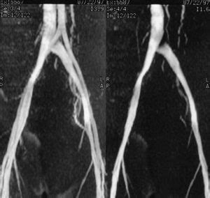 May Thurner Syndrome - Alaska Vein Clinic