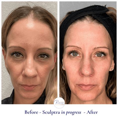 Sculptra Renew Medical Aesthetics