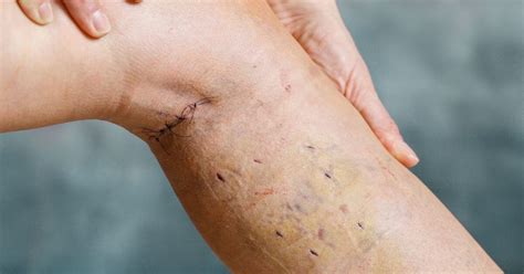 Ambulatory Phlebectomy For Varicose Veins What To Expect