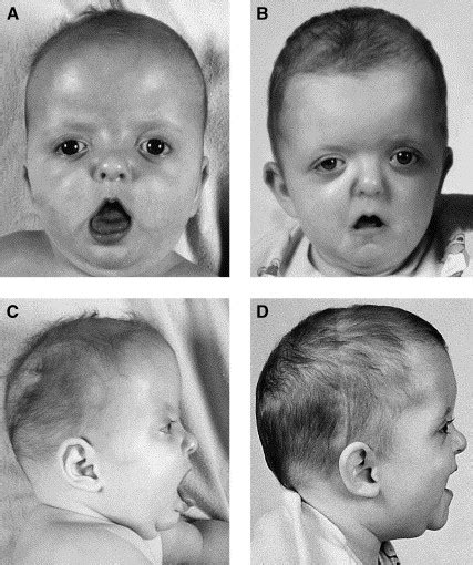 Craniofacial Dysostosis Syndromes Stages Of Reconstruction Oral And