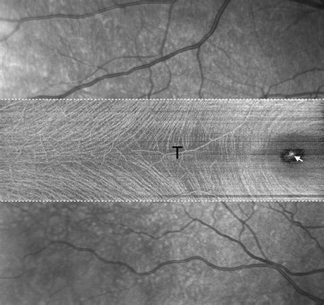 Imaging Of The Temporal Raphe With Optical Coherence Tomography