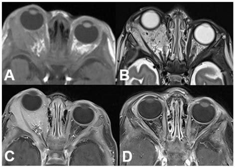 Orbital Tumorsclinical Radiologic And Histopathologic Correlation