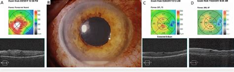 Oct And Slit Lamp Presentation Of The Reported Case A Optical