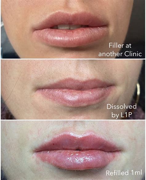 Lip Filler Migration Massage And How To Prevent Freaktofit