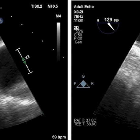 Left atrial appendage morphology as seen on transesophageal ...