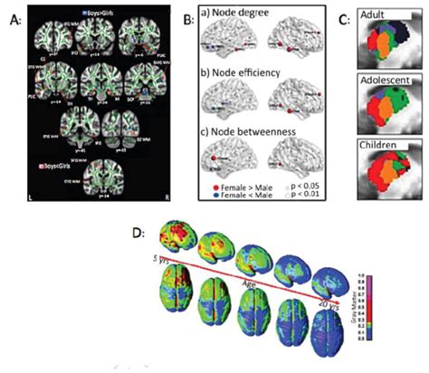 Sex And The Migraine Brain Pmc