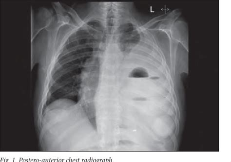 Traumatic Diaphragmatic Hernia