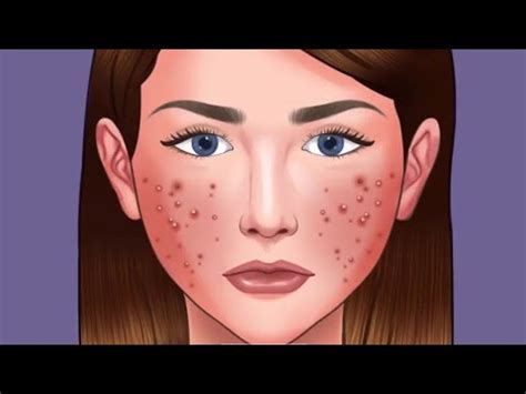 ASMR ACNE REMOVAL SKIN CARE ANIMATION Asmr Animation Makeup