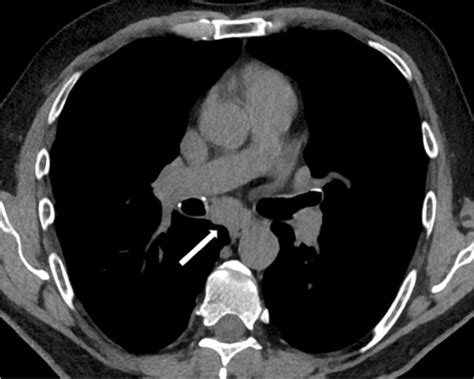 Enlarged subcarinal lymph node (white arrow) without calcifications | Download Scientific Diagram