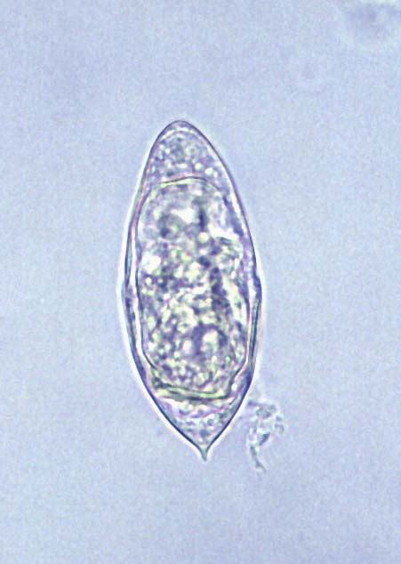 Pathology Outlines Schistosomiasis