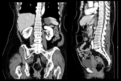 Hundred Ct Scan Pelvis Royalty Free Images Stock Photos Pictures