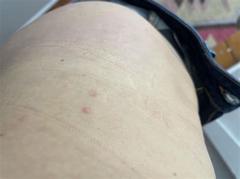 Round dry spots - anyone identify this? : r/skin