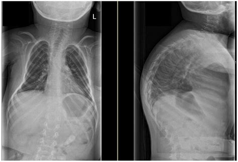 Pediatric Spinal Deformities