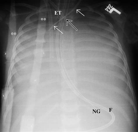 Medical Devices Of The Chest RadioGraphics