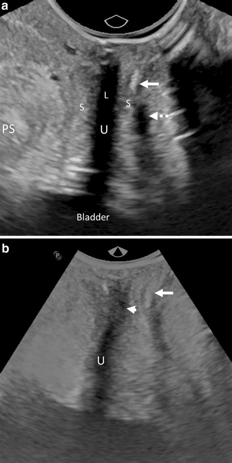 Sagittal D Grayscale Ultrasound Image With Image Gain Optimized To