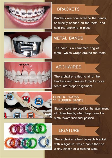 Braces Elastics Bracket At Matthew Creek Blog