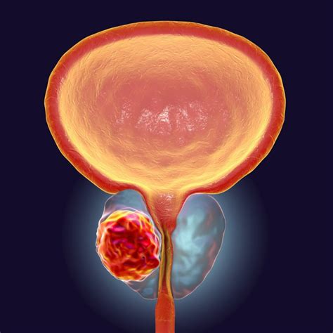 Prostat Kanseri Belirtileri Tedavi Ve Ameliyat Fiyat Ankara